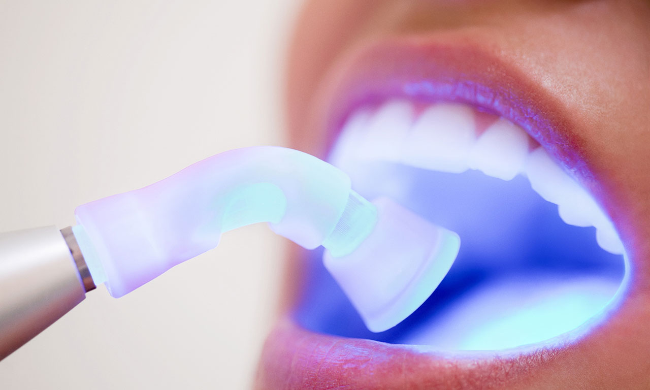 Отбеливание зубов в домашних условиях 🦷 10 лучших способов отбелить зубы дома 👄 | CIS